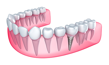 Dental Implants Grand Rapids, MI Dentist